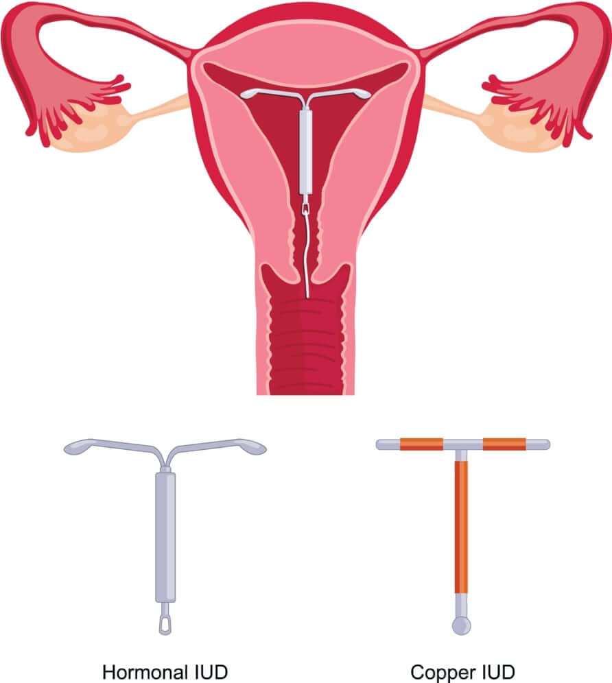 vòng tránh thai trị u xơ tử cung