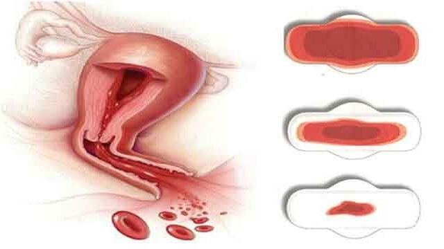chảy máu tử cung bất thường do u xơ tử cung