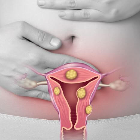 Vị trí u xơ tử cung có ảnh hưởng đến thai nhi